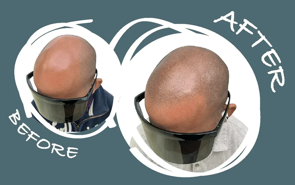 Before and after SMP density treatment on a bald male crown at Derma Follic SMP San Francisco