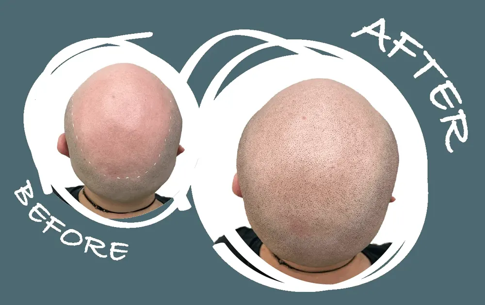 Before and after shaved-head SMP treatment on a male client for a natural bald look