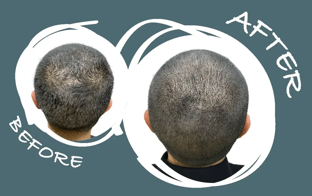 Before and after SMP crown density treatment on a male client at Derma Follic SMP