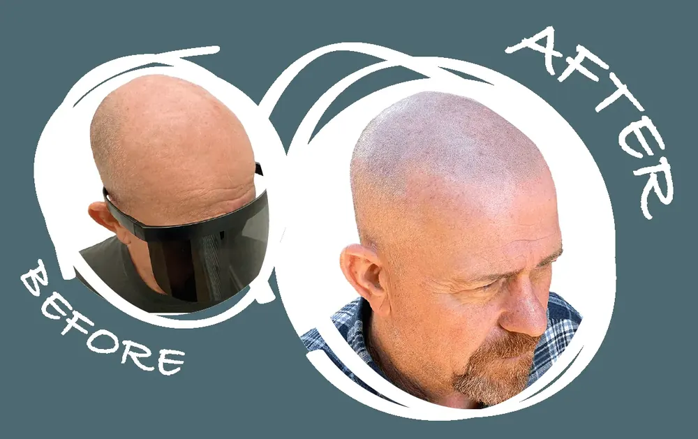 Before and after full-scalp scalp micropigmentation on a male client, side view