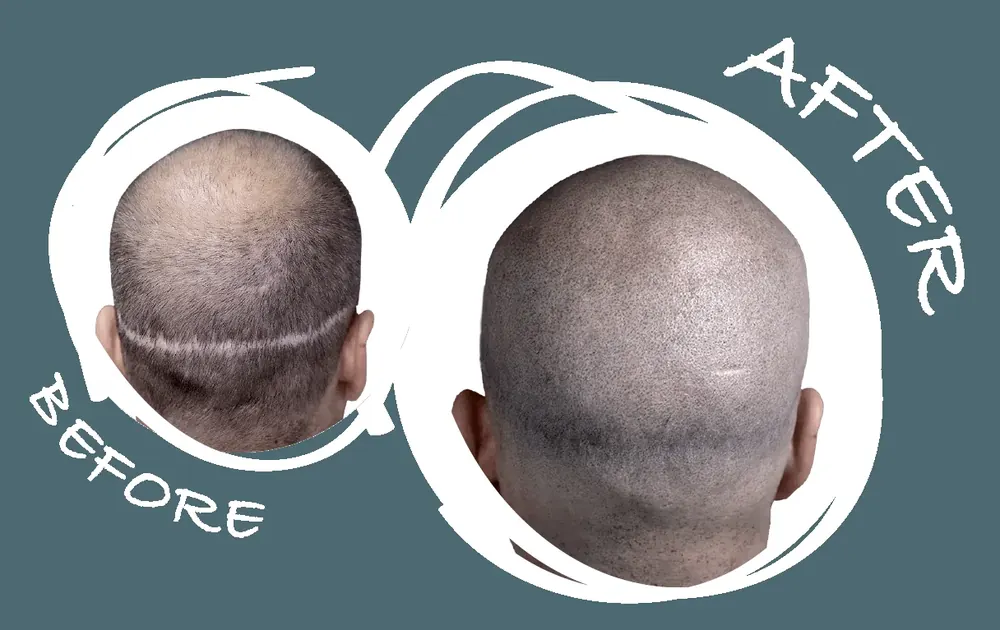 Before and after FUT hair transplant scar camouflage with scalp micropigmentation