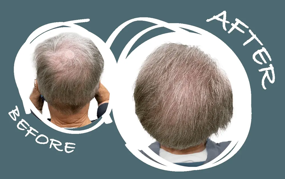 Before and after scalp micropigmentation on a mature male with grey thinning crown hair