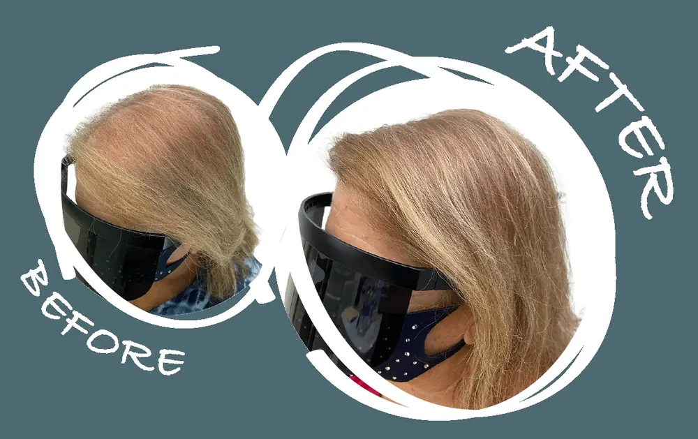Before and after scalp micropigmentation density treatment along the part line for a female client
