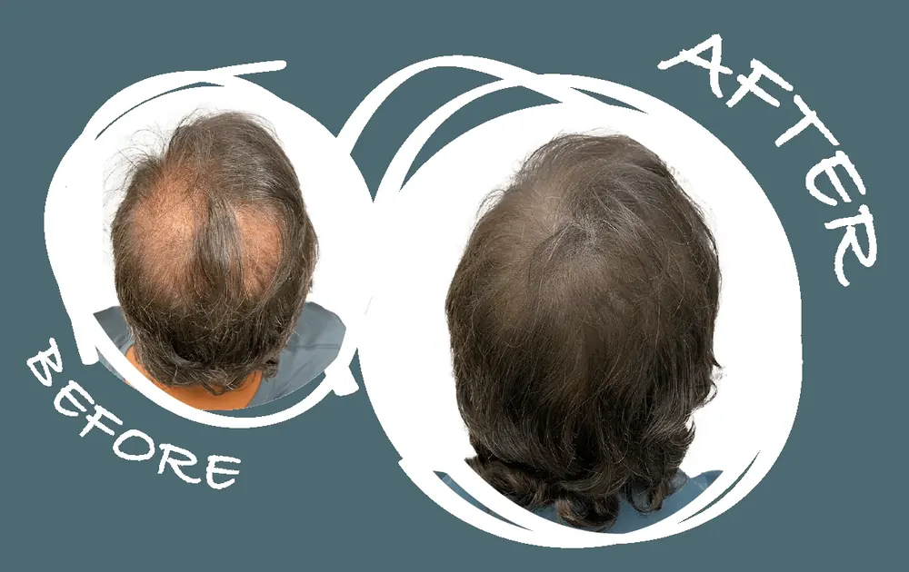 Before and after SMP density treatment for a female client with a thinning crown